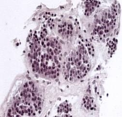 Diagnosticul tumorilor bronhopulmonare benigne